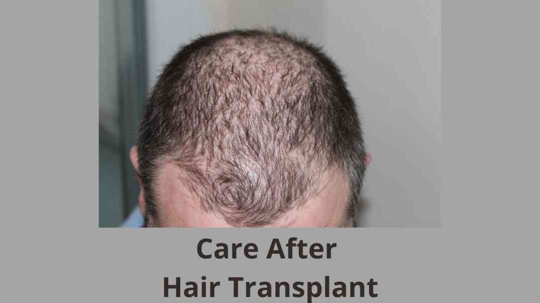 How To Take Care After Hair Transplant