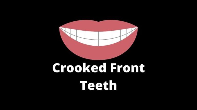Crooked Front Teeth