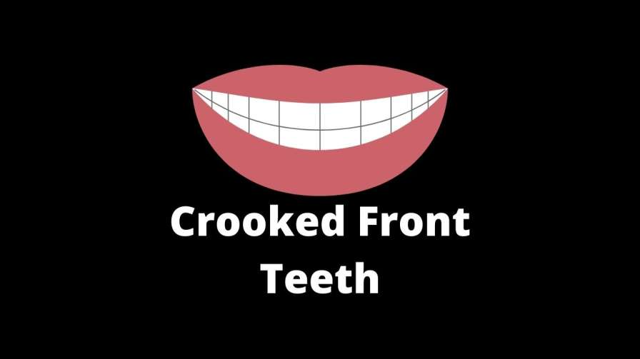 Crooked Front Teeth