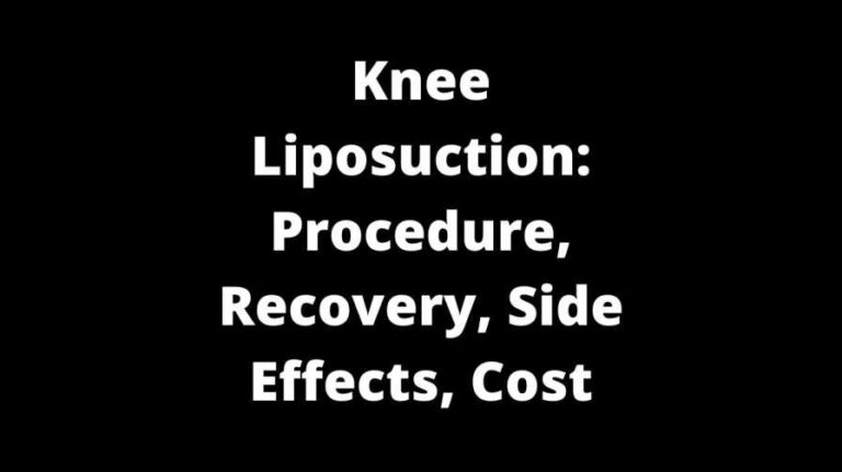 Knee Liposuction: Procedure, Recovery, Side Effects, Cost